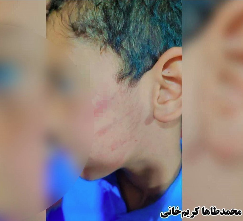 Saravan: Beating and injuring a Baloch child by his teacher